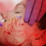 PRP FOR FACE TREATMENT (VAMPIREFACE)